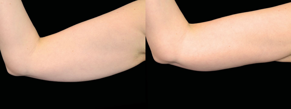 Arms Fat Reduction and Skin Tightening