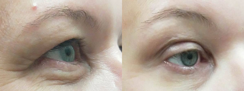 non surgical upper and lower blepharoplasty