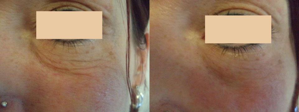 non surgical upper and lower blepharoplasty
