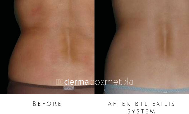 exilis before after