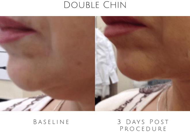 double chin before after