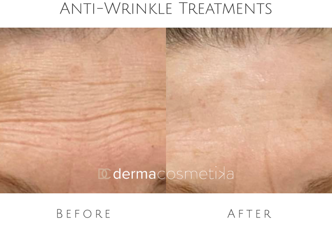 anti wrinkle treatments