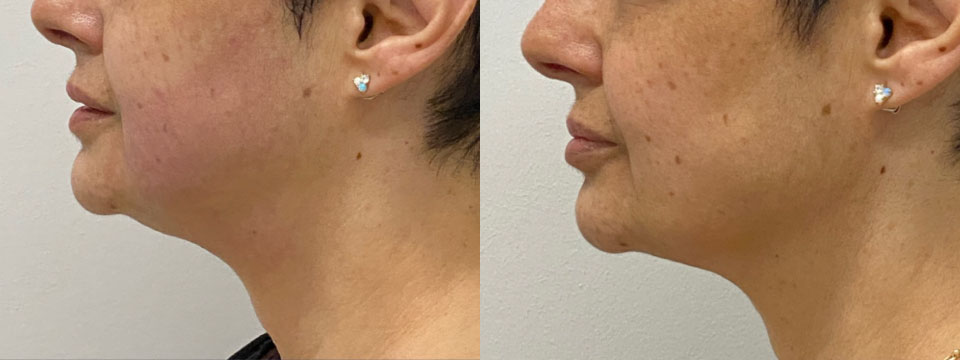 double chin treatment sydney