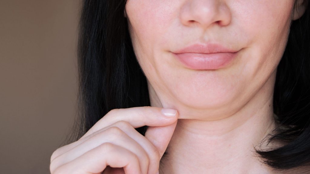 double chin surgery