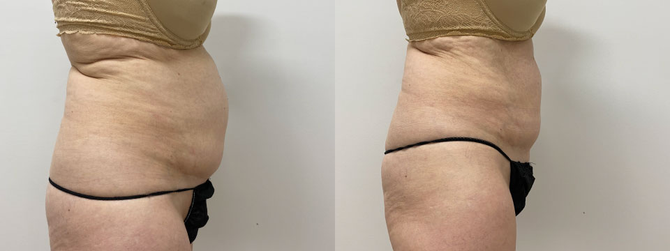 fat freezing before after