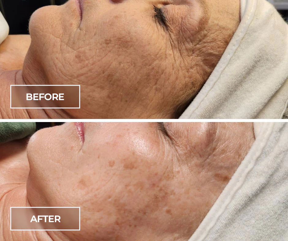 SWiCH treatment before and after result 1