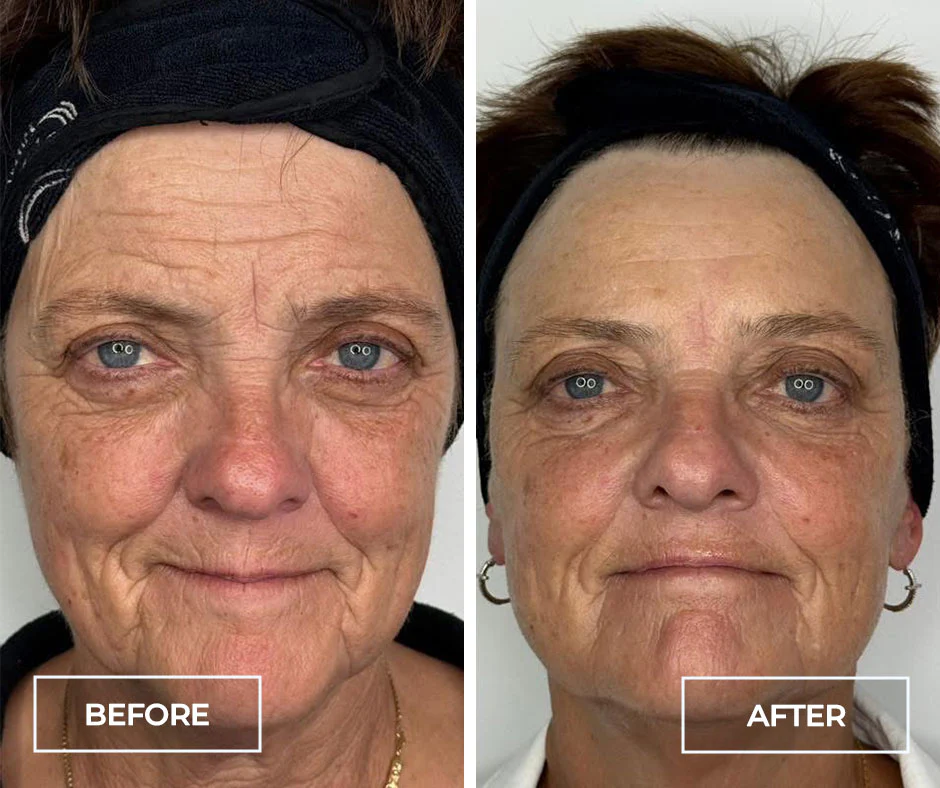 SWiCH treatment before and after result 2