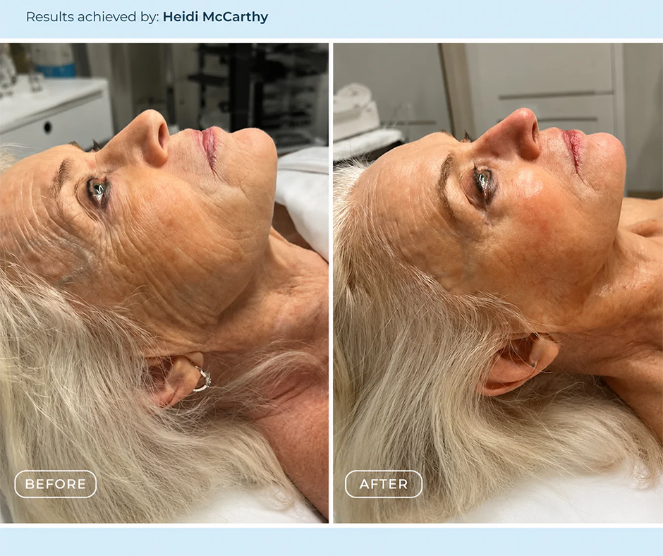 SWiCH treatment before and after result 7